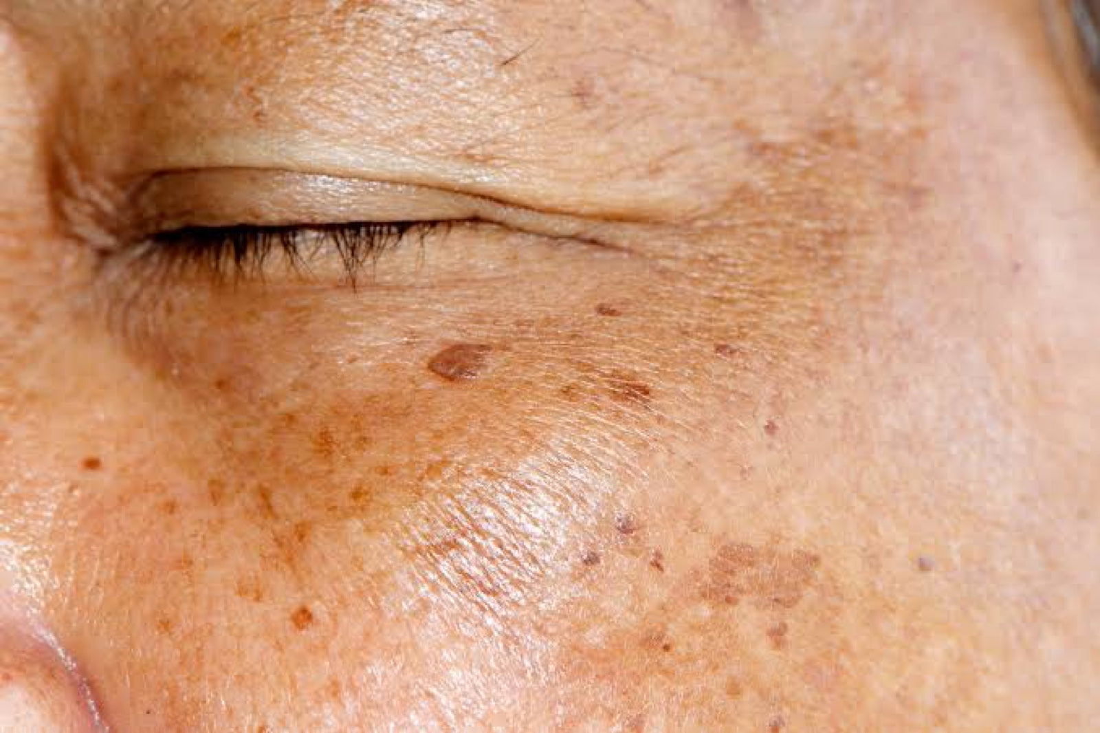 Close view of dark spots and pigmentation on a cheek