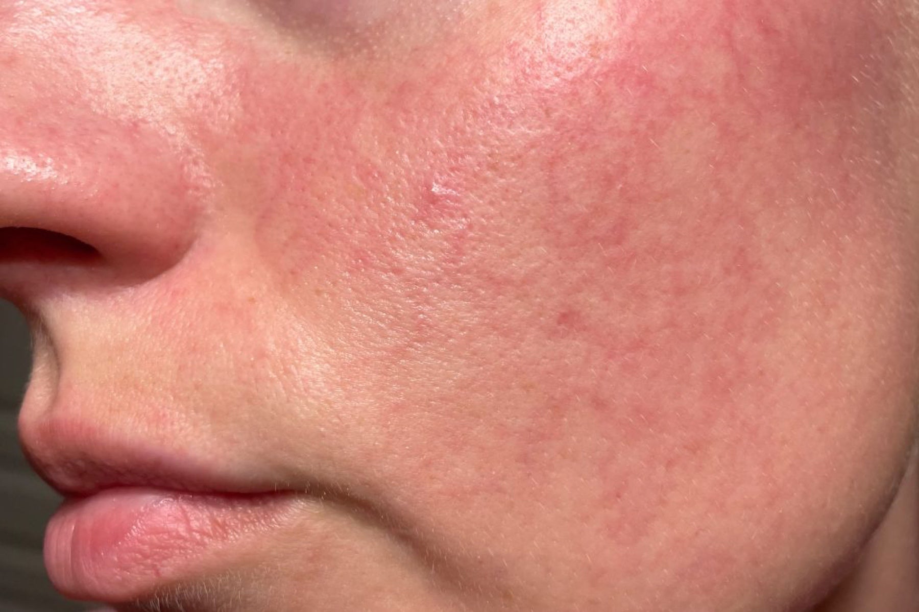Close view of visible redness on a cheek